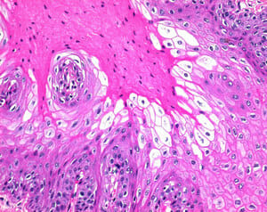 Dane's Method for Prekeratin, Keratin, and Mucin