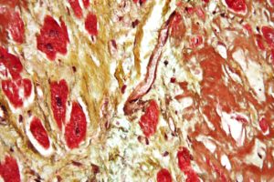 Modified Movat's Stain