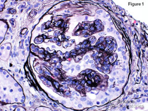 Jones Method for Kidney