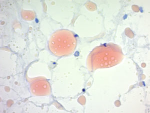Fat Stains in Supersaturated Alcohol