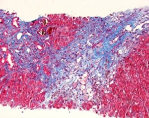 Carstairs Method for Fibrin and Platelets